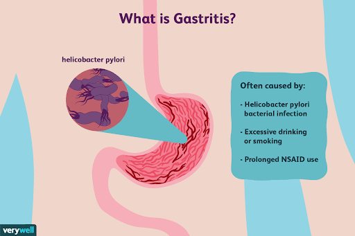 Gastritis atau radang lambung