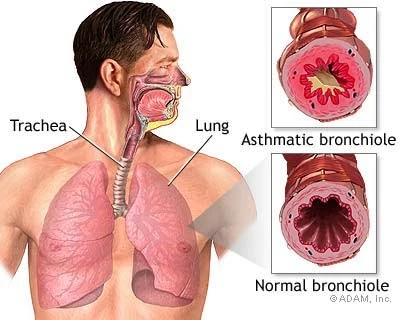 Apa itu asma bronkial?